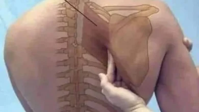  مرض كتف الأبوة النادر