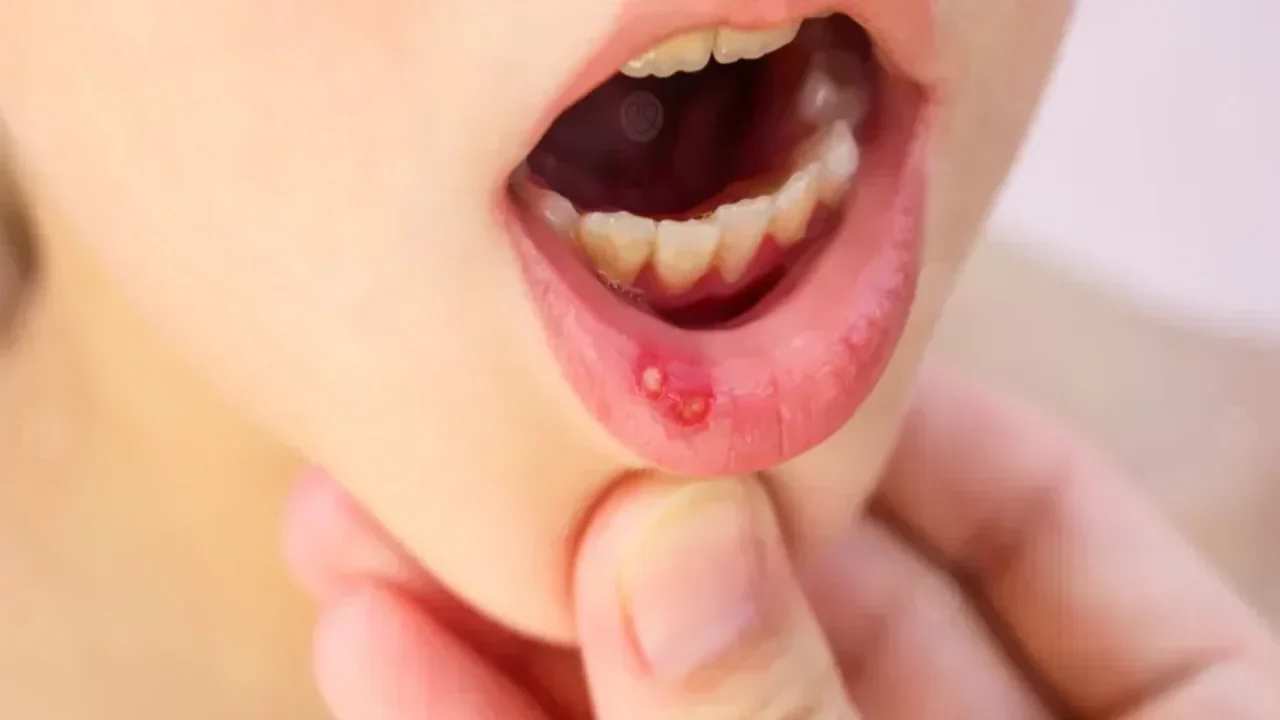 علاج التهاب الفم stomatitis | ما هو وأسبابه وأعراضه وكيفية العلاج والوقاية