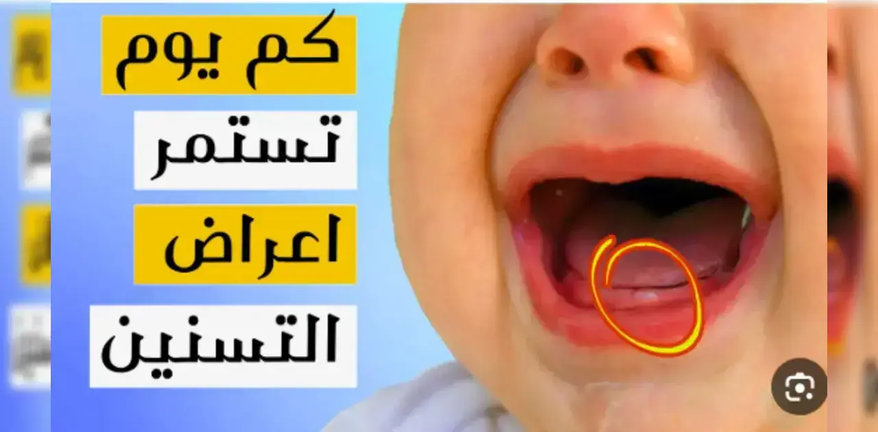 ما هي أبرز أعراض التسنين عند الأطفال؟